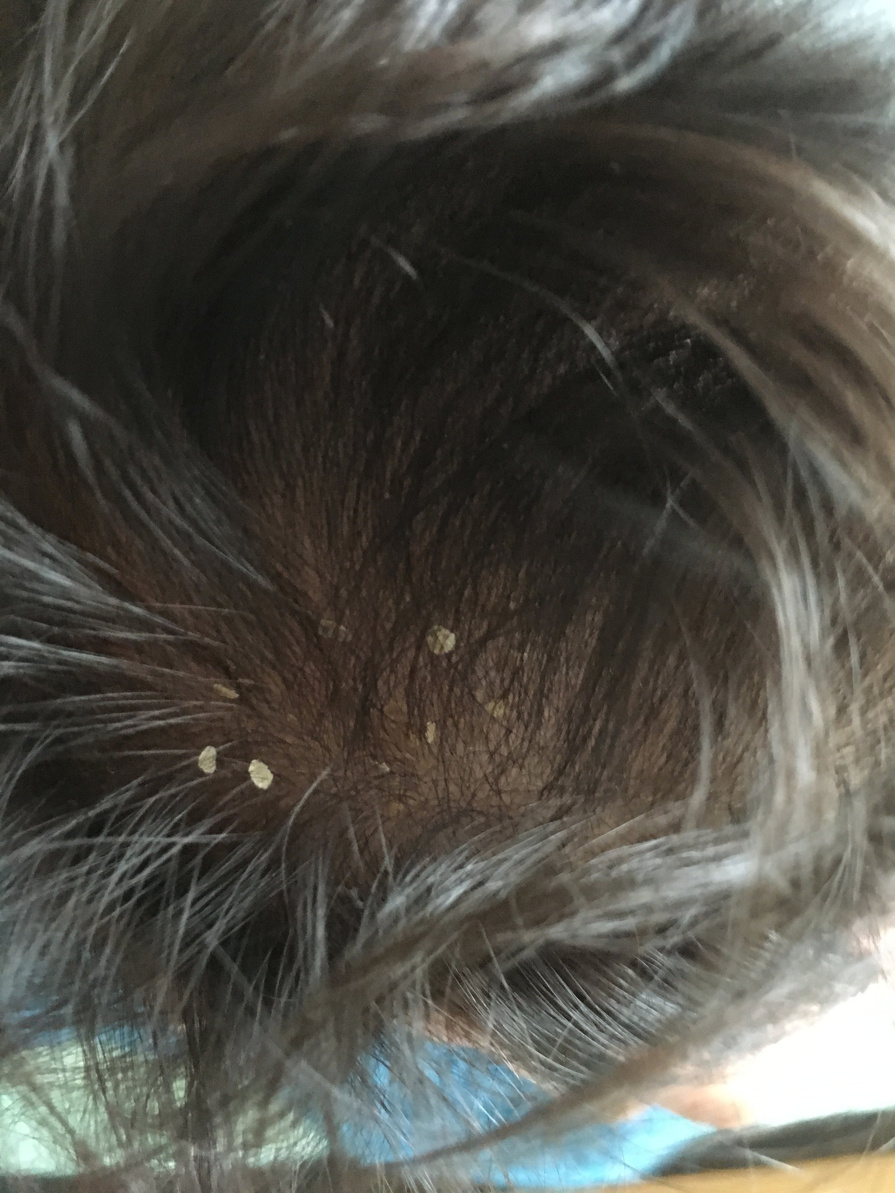 赤ちゃんの頭皮にかさぶた うろこみたいな乳児脂漏性湿疹が解決された経緯 プレママ初期から読んで欲しいブログ